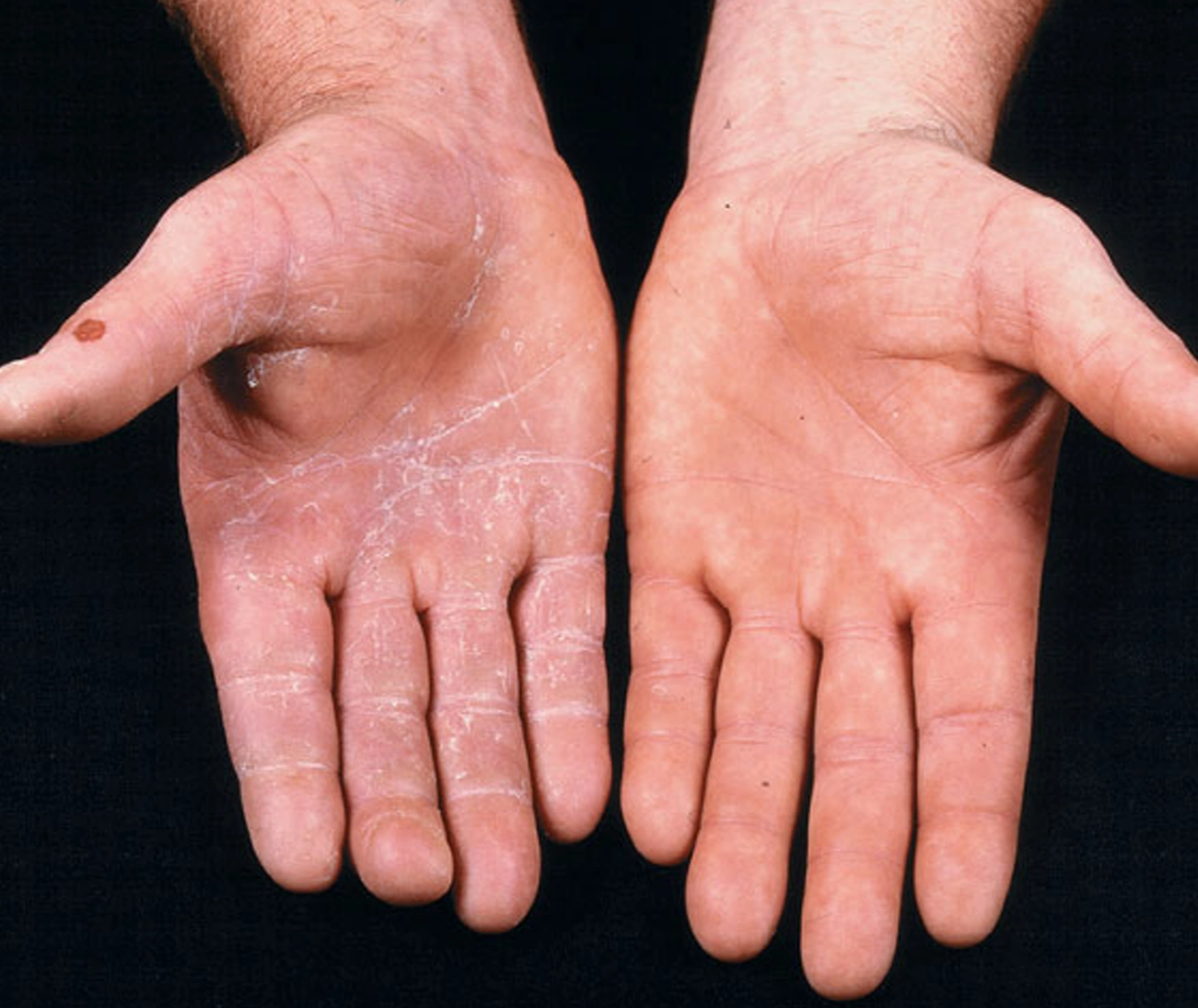 Tinea manus, tampak eritema dan skuama pada telapak tangan kanan (Kang dkk, 2019)