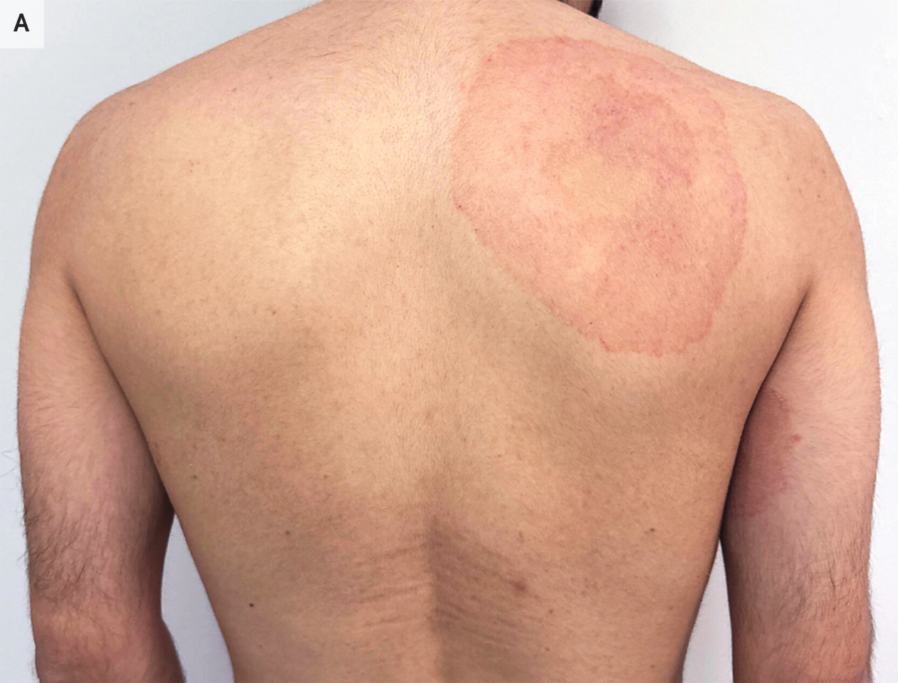 Tinea corporis pada punggung (Xu dkk, 2024)