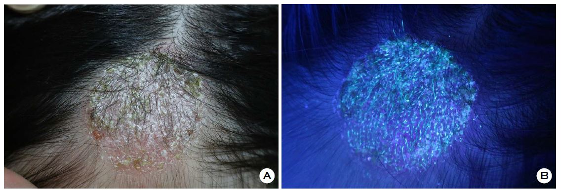 Fluoresensi hijau pada Microsporum sp. (Sun dkk. 2025)