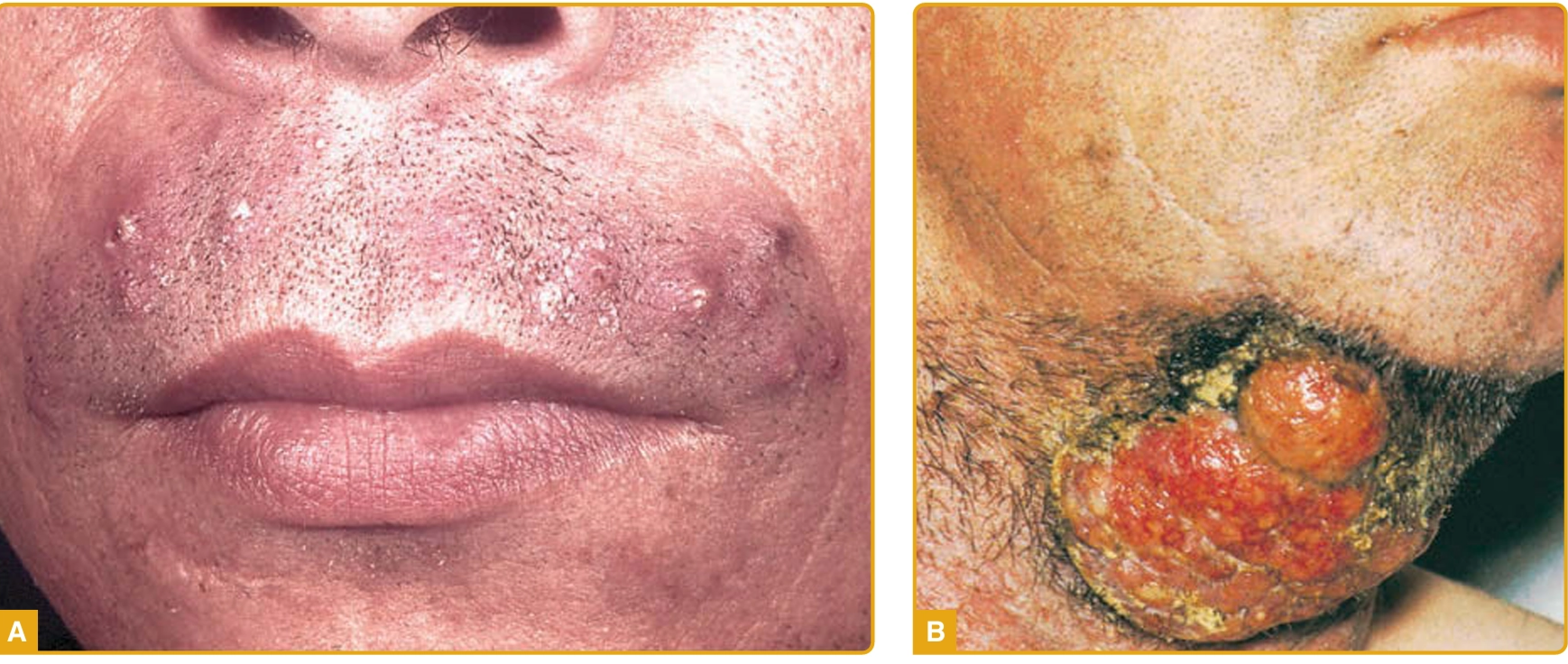 Tinea barbae A. tipe superfisial; B. tipe kerion/inflamasi (Kang dkk, 2019)