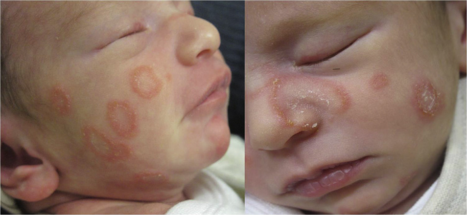 Tinea facialis multipel (Bassi dkk, 2016)
