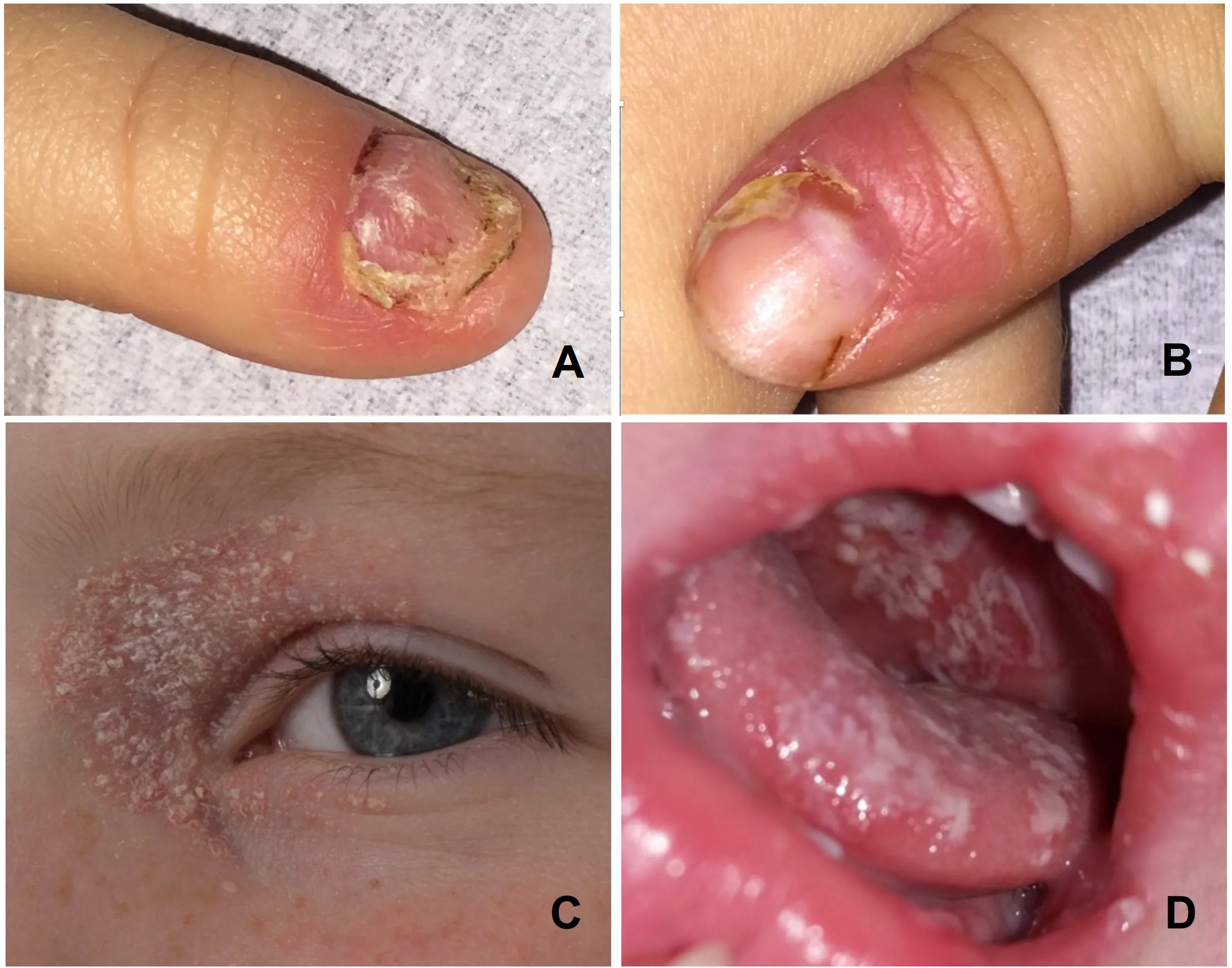 Kandidiosis mukokutan pada kuku, wajah, dan cavum oris (Fink dkk, 2024)