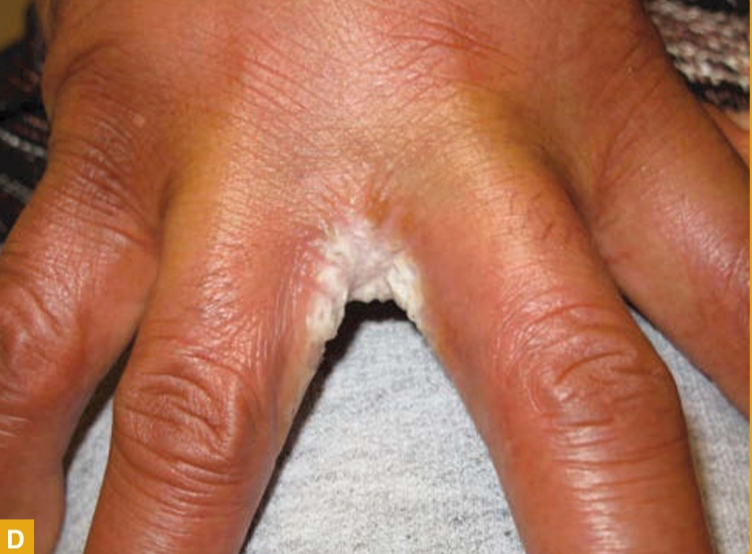Kandidiosis interdigital menunjukkan plak eritema dengab erosi pada area interdigital (Kang dkk, 2019)