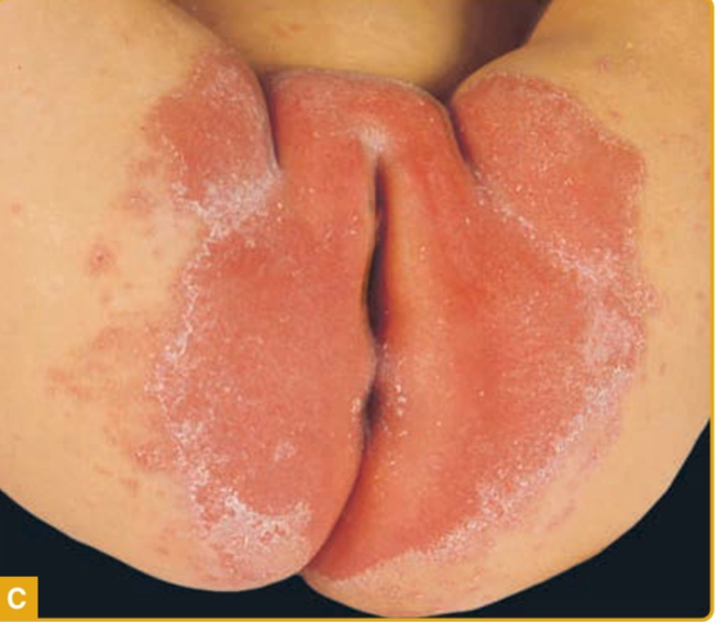 Kandidiosis diaper (Kang dkk, 2019)