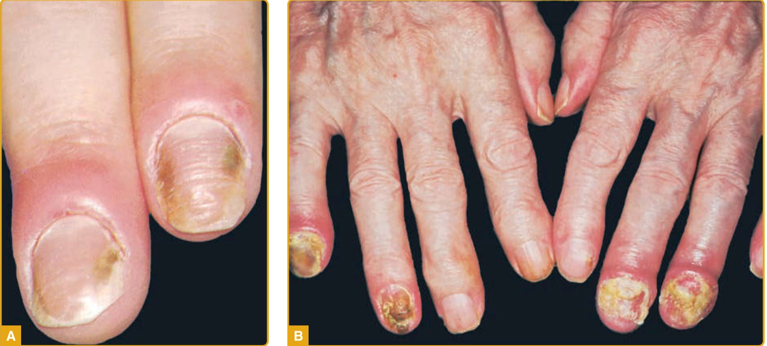 A. Paronikia kronis akibat Candida albicans dengan edema dan eritema dari jaringan periungual dan onikolisis; B. Paronikia berat yang telah menyebar ke lempeng (onikomikosis)