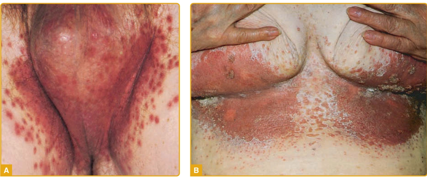 Kandidiosis intertriginosa dengan papul eritema konfluen dan lesi satelit A. Pada inguinal dengan keterlibatan skrotum; B. Pada area inframammae (Kang dkk, 2019)
