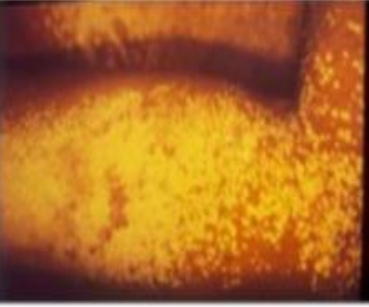 Gambaran lampu Wood dari Pityriasis versicolor (Januwarsih dkk, 2022)