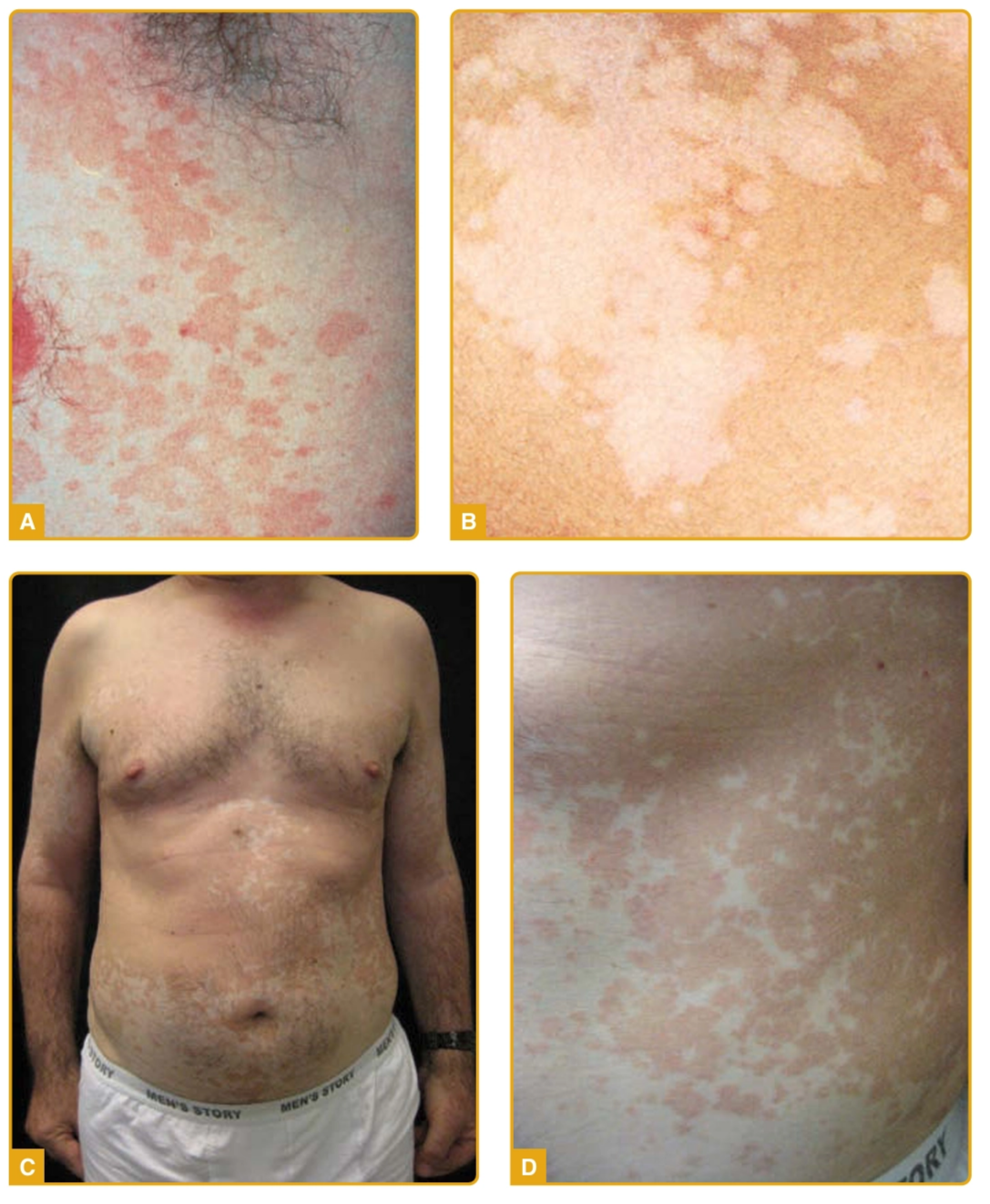 Pityriasis versicolor A. Patch dan makula eritem B. Patch dan makula hipopigmentasi C. Patch berwarna pink salmon D. Gambaran skuama halus pada pityriasis versicolor (Kang dkk, 2019)
