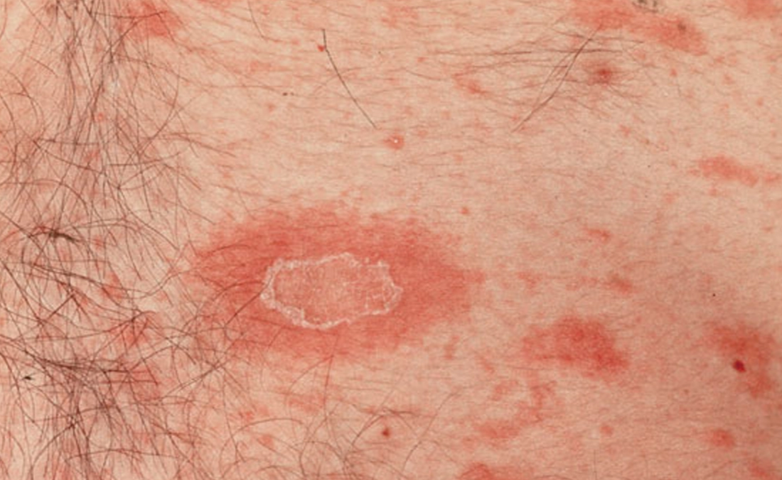 Herald patch (plak eritema dengan collarette scale pada tepi lesi) pada pitiriasis rosea (Saavedra dkk, 2023)