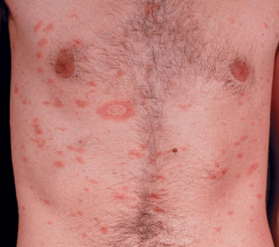 Pitiriasis rosea stadium erupsi (Saavedra dkk, 2023)