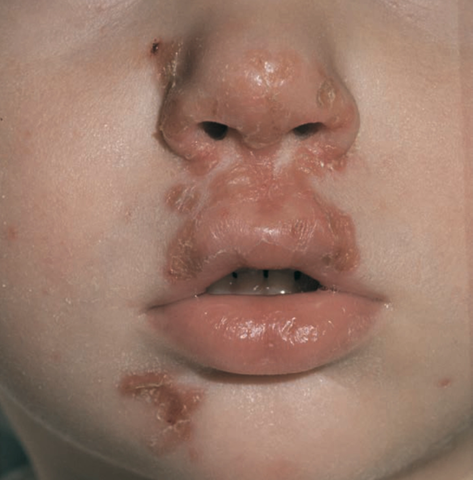 Impetigo krustosa dengan krusta yang konfluen pada area hidung, pipi, dan bibir (Saavedra dkk, 2023)