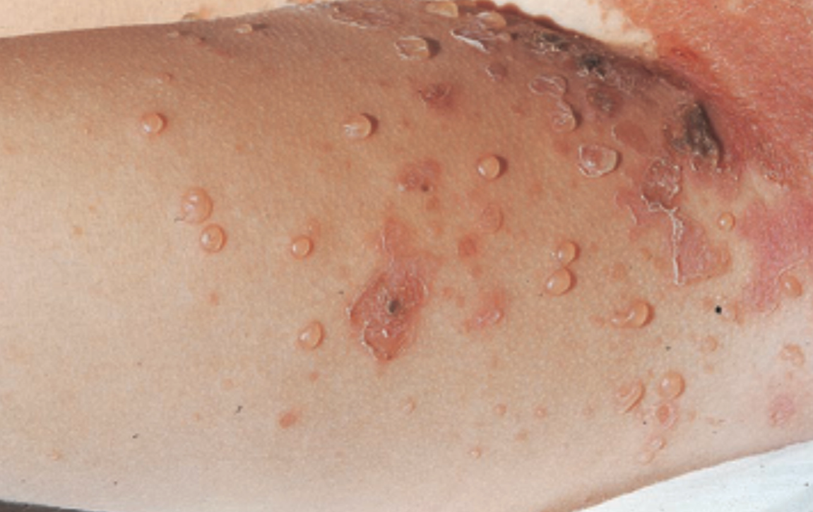 Impetigo bulosa dengan gambaran bullae multipel berdinding tipis tersebar secara diskrit (Saavedra dkk, 2023)