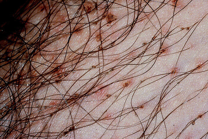 Pedikulosis pubis dengan macula cerulea (Ko & Elston, 2004)