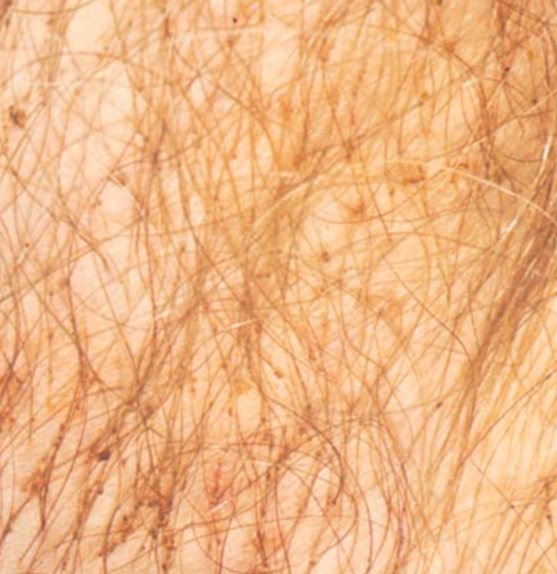 Pedikulosis pubis dengan nits yang menempel pada rambut (Kang dkk, 2019)