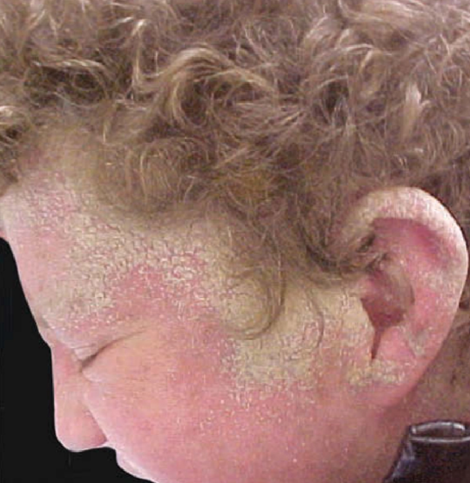 Crusted scabies dengan plak hiperkeratotik yang berisi banyak tungau(Kang dkk, 2019)