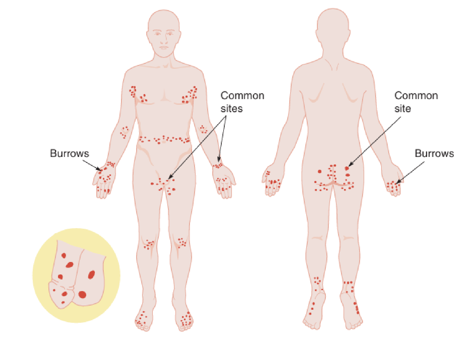 Area predileksi Scabies (Saavedra dkk, 2023)
