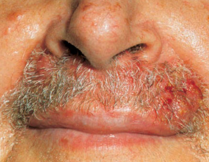 Folikulitis profunda pada area bibir atas (sycosis barbae) (Kang dkk, 2019)