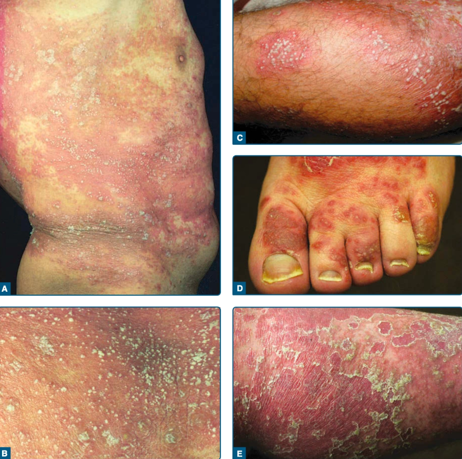 Psoriasis pustulosa (Kang dkk, 2019)