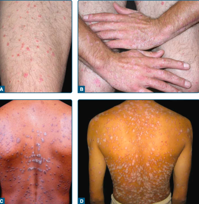 Psoriasis guttata (Kang dkk, 2019)
