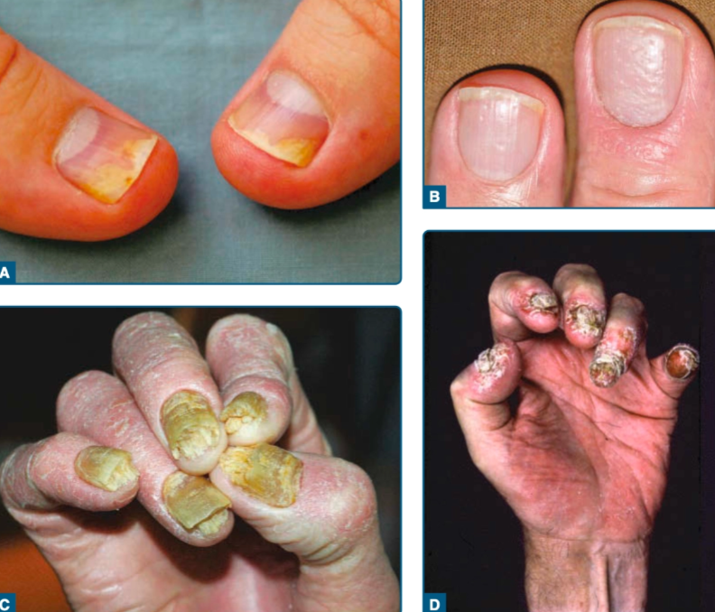 Keterlibatan kuku pada psoriasis. A. Onikolisis distal B. Nail pitting C. Subungual hiperkeratosis D. Onikodistrofi (Kang dkk, 2019)