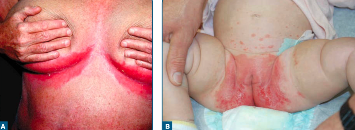 Psoriasis inversa (Kang dkk, 2019)