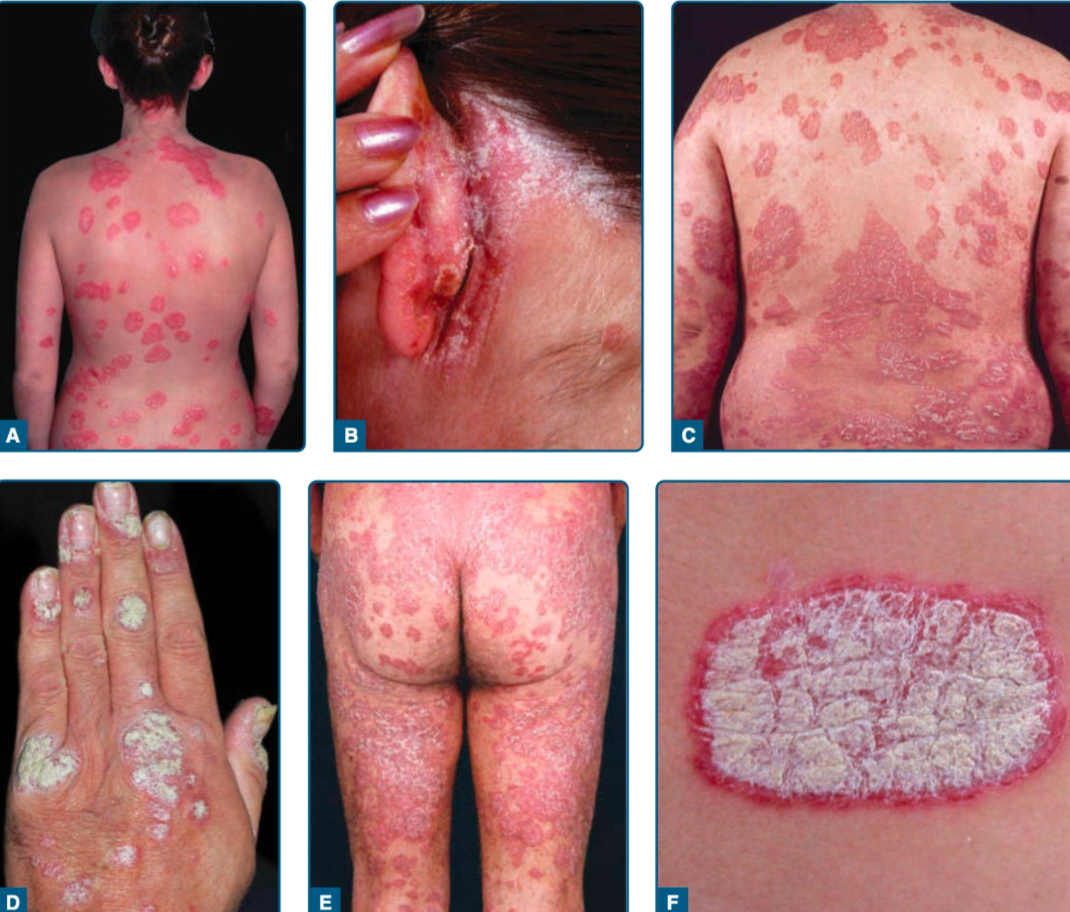 Psoriasis vulgaris (Kang dkk, 2019)