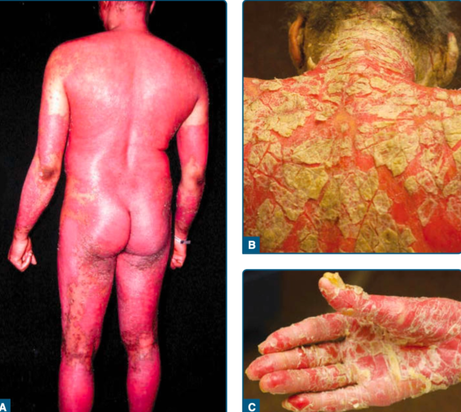 Psoriasis eritrodermik (Kang dkk, 2019)