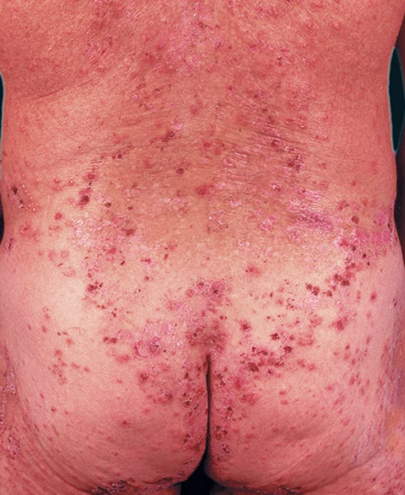 Dermatitis herpetiformis generalisata tampak papul berkelomok, vesikel-vesikel kecil di atas dasar kulit eritema, krusta, dan erosi (Saavedra dkk, 2023)
