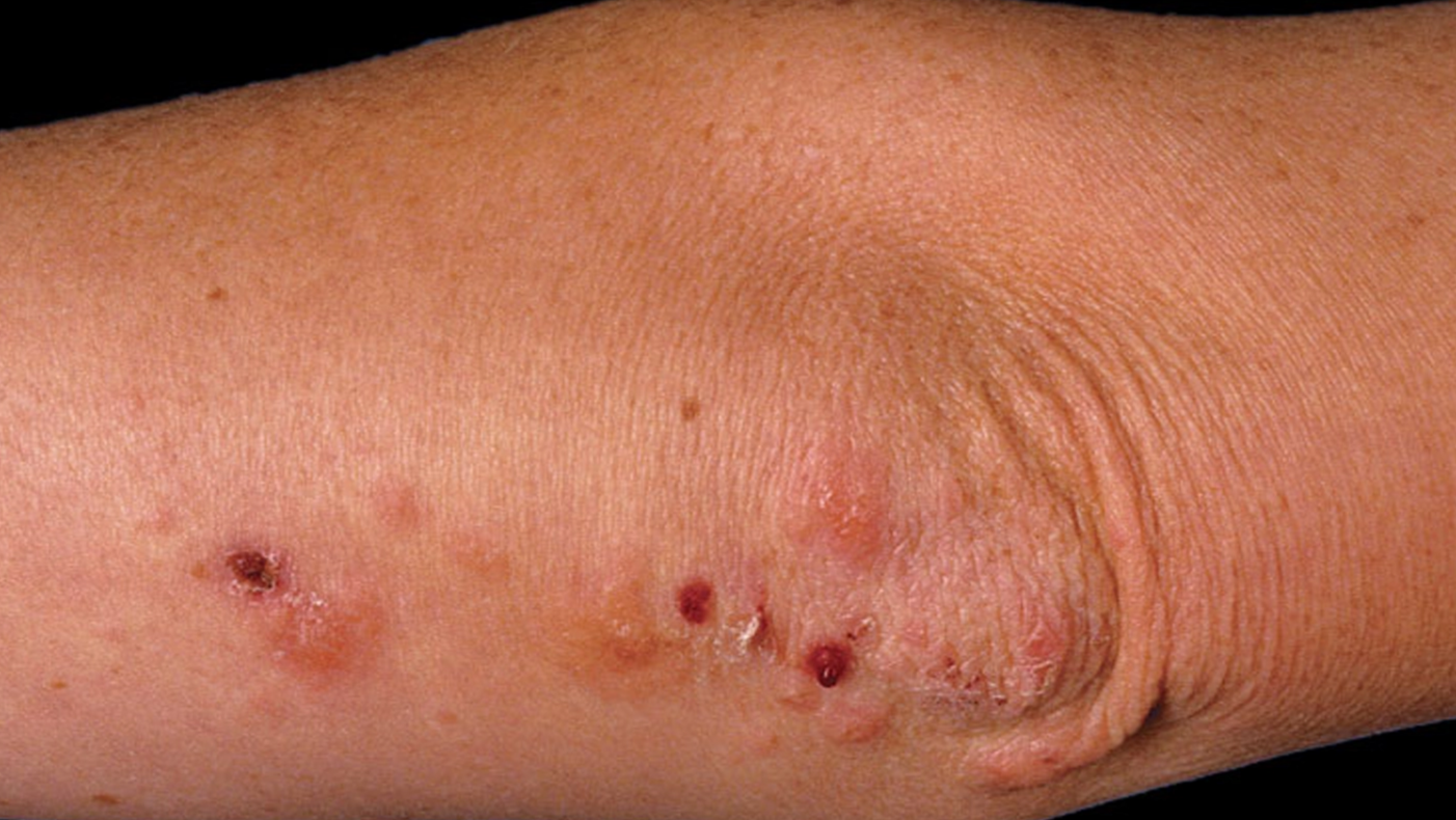 Lesi awal dermatitis herpetiformis dengan papul, plak urtikaria, vesikel kecil berkelompok dan krusta (Saavedra dkk, 2023)
