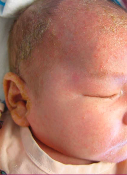 Dermatitis seboroik tipe infantil dengan cradle cap (Kang dkk, 2019)