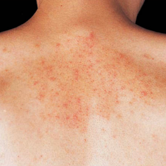 Dermatitis seboroik dewasa pada punggung (Kang dkk, 2019)