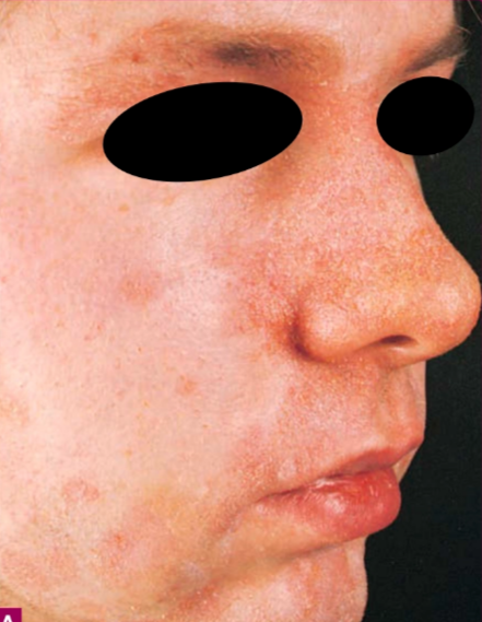 Dermatitis seboroik dewasa pada lipatan nasolabial (Kang dkk, 2019)