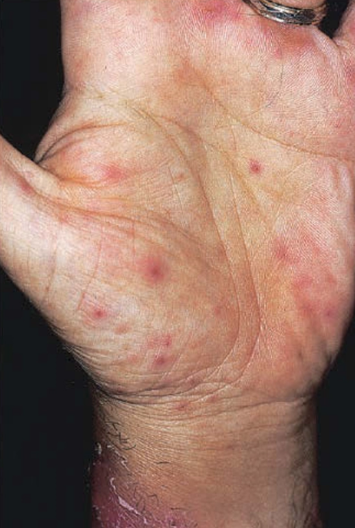 Kandidiosis diseminata pada pasien AML, tampak papul dan nodul eritema pada tangan dengan pustulasi sentral (Kang dkk, 2019)
