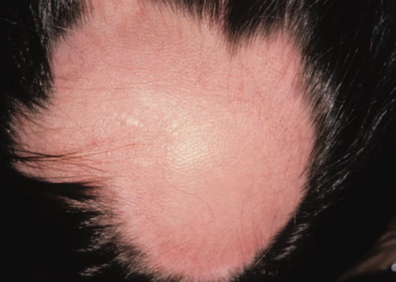 Lesi soliter alopecia areata (Saavedra dkk, 2023)