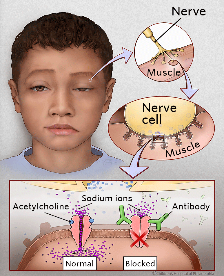 (https://www.chop.edu/conditions-diseases/Miastenia-gravis)