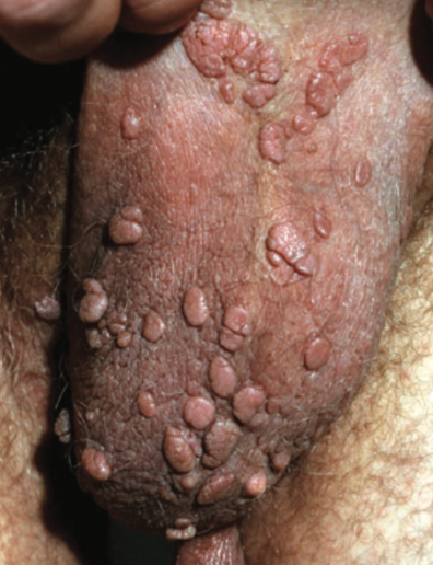 Condyloma acuminata pada scrotum (Saavedra dkk, 2023)