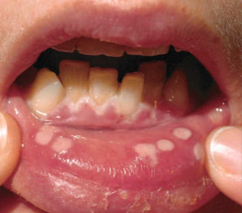 Gingivostomatitis akibat herpes (Kang dkk, 2019)