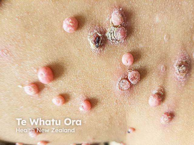 Tampilan close-up moluskum multipel — tampak umbilikasi, inflamasi, dan eksema di sekitarnya. (https://dermnetnz.org/)