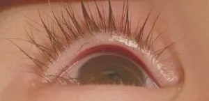 Distikiasis (https://www.aao.org/)