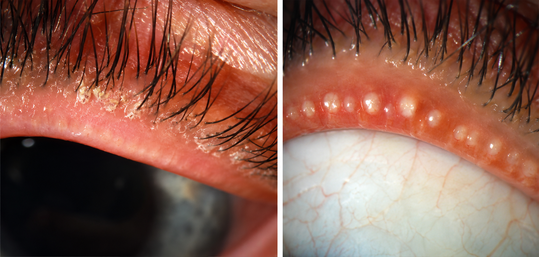 Blefaritis anterior dan posterior (https://www.eyeworld.org + AI)