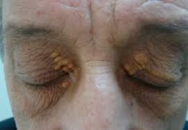 (https://eyewiki.org/)