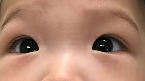 https://eyewiki.org/