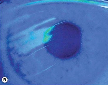 Gambaran uji fluorescein menunjukkan erosi linier (Salmon, 2025 + AI)