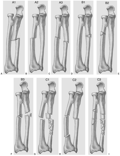 (Orthopaedic Trauma Association classification for radius and ulna fractures. A: Type A1—simple ulna, radius intact. B: Type A2—simple radius, ulna intact. C: Type A3—simple fractures of radius and ulna. D: Type B1—wedge fracture of ulna, radius intact. E: Type B2—wedge fracture of radius, ulna intact. F: Type B3—wedge fractures of radius and ulna. G: Type C1—complex ulnar fracture with simple radius fracture. H: Type C2—complex radius fracture with simple ulna. I: Type C3—complex fractures of both the radius and ulna.)