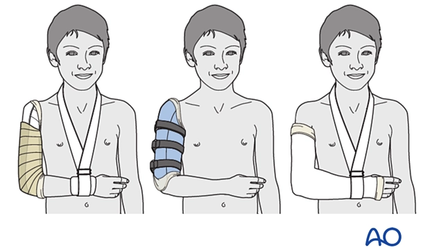 U-slab splint (temporary treatment), Sarmiento Brace, Hanging cast (https://surgeryreference.aofoundation.org/)