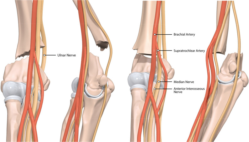 Figure 2 Examples of displaced flexion-type supracondylar fracture (left two figures) and extension-type supracondylar fracture (right two figures) with overlying neurovascular structures. (https://www.jposna.com/)