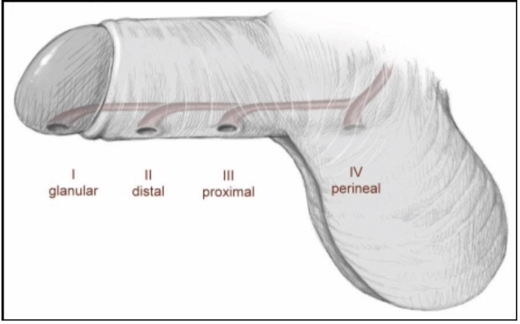 (https://www.hypospadias.net/)